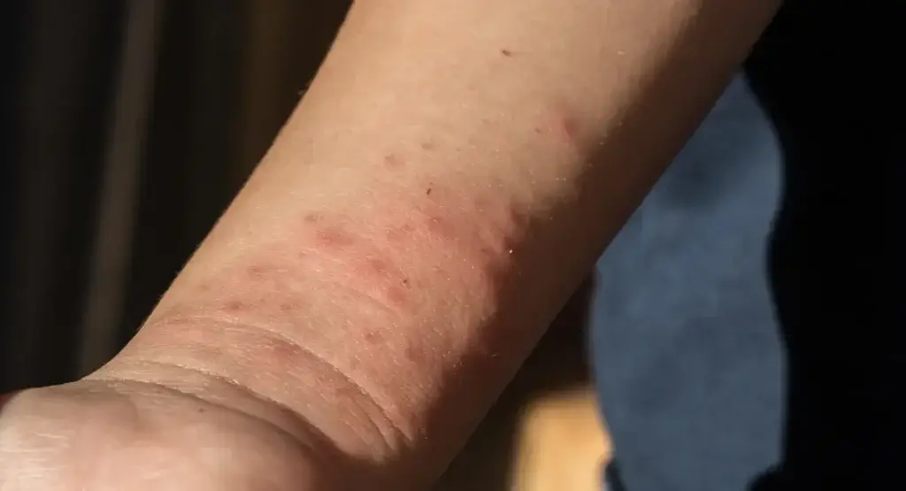Picture of a person's arm with bed bug bites.
