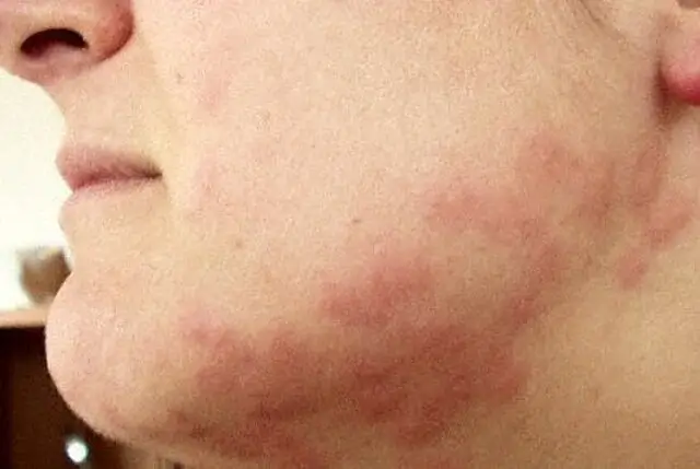bed bug control symptoms
